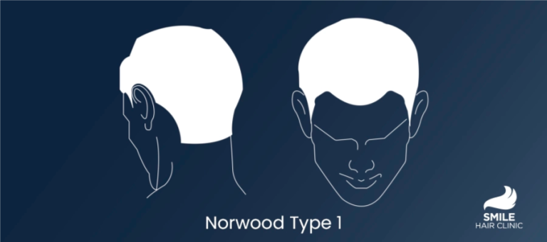 Norwood Type 1 Hair Loss and Treatment Options