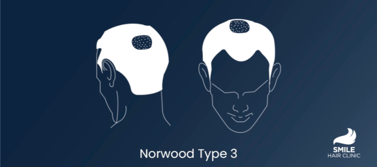 Norwood Type 3 Hair Loss