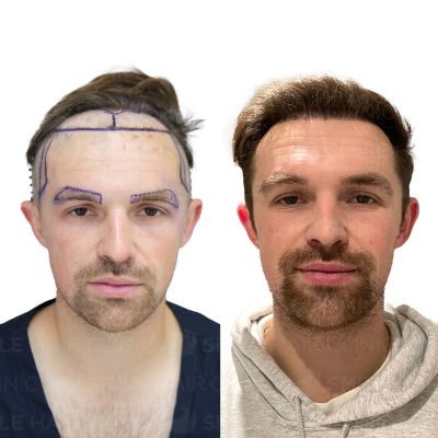 2500 Grafts - TOM TIGWELL