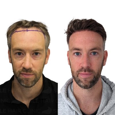 3000 Grafts - ROSS STEVEN ROY