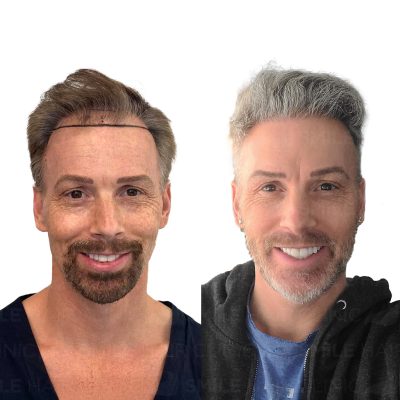 3100 Grafts - CHAD MATTSON