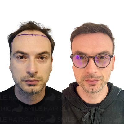 3500 Grafts - PANAGIOTIS GERONTOPOULOS