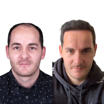 4000 Grafts - DEAN NORMAN