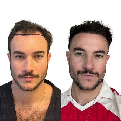 4000 Grafts - ERIC TUMOLO