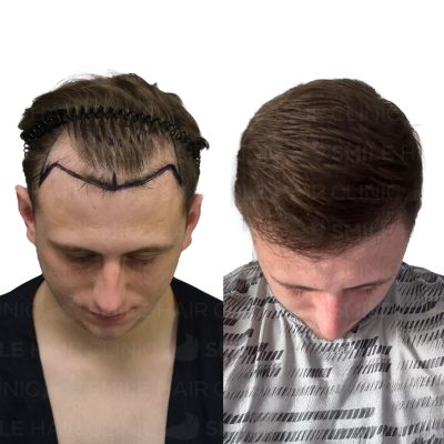 4000 Grafts - NATHAN MORTLOCK