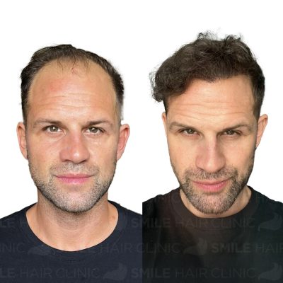 4100 Grafts - AURY BARNETT