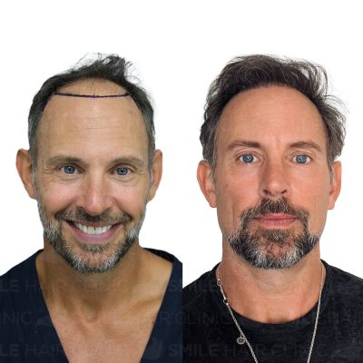 4100 Grafts - ROBERT MUMBY