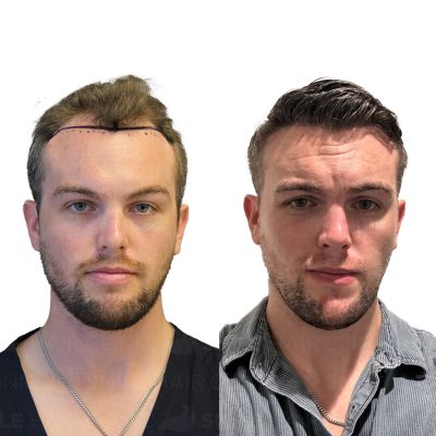 4250 Grafts - DONAL FITZGIBBON