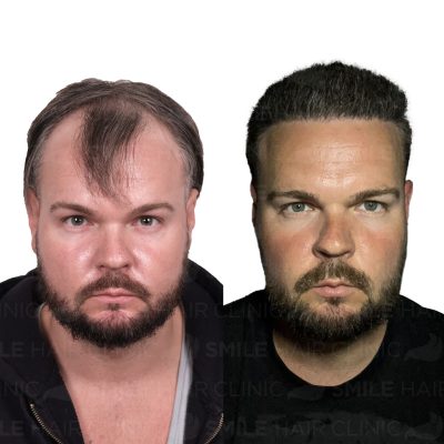 4250 Grafts - KYLE BLOCKLEY