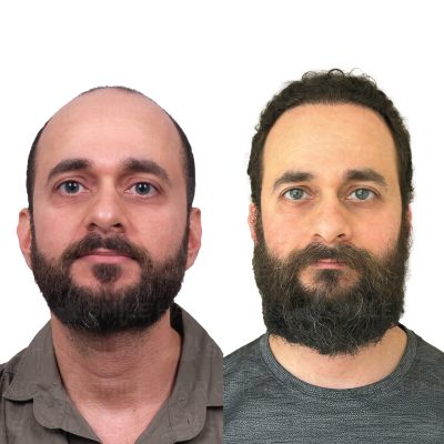 4500 Grafts - RAMSICE JARJEES