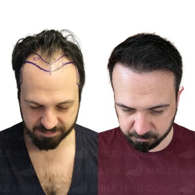 4600 Grafts - ERDEM BICIRDI