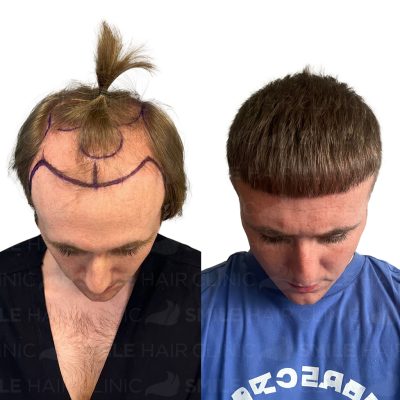 4700 Grafts - LEWIS ANDERSON