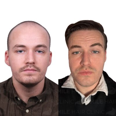 4700 Grafts - SINDRE MATHIAS SKRODAL