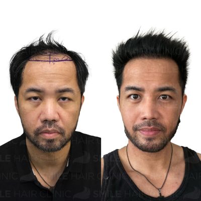 4850 Grafts - RICHARD SOLNES