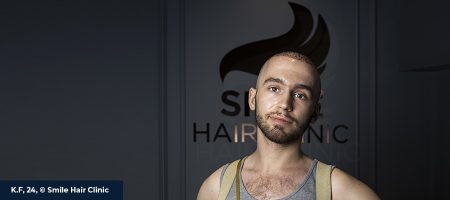 Bodry-Hair-Transplant