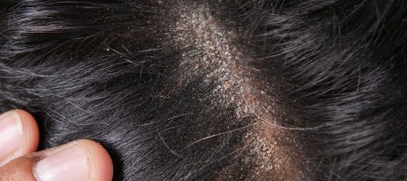 Haartransplantation-Narben-2000x750