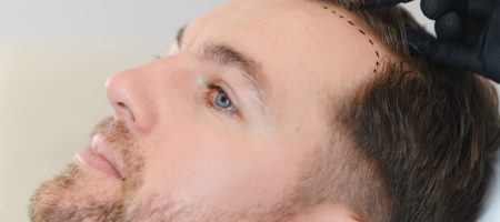 Haartransplantation-Risiken-2000x750