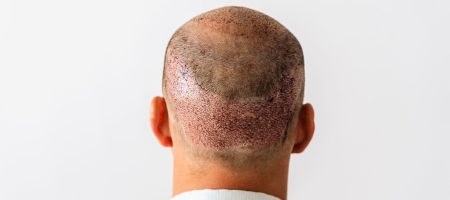 Haartransplantation-Woher-Haare-2000x750