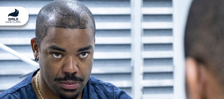 Hair Transplant in Texas