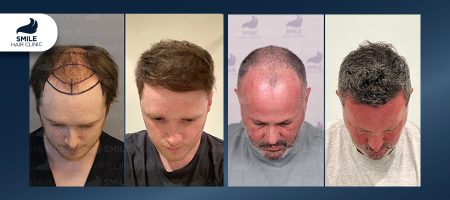 Real-Patient-Reviews-Comparing-Hair-Transplants-in-Dallas-Houston-and-Istanbul