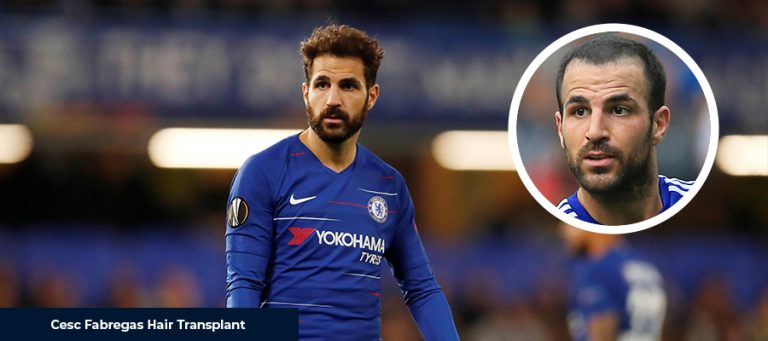 Greffe de cheveux de Cesc Fabregas