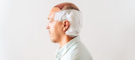Krusten-nach-Haartransplantation-scaled-1-900x400
