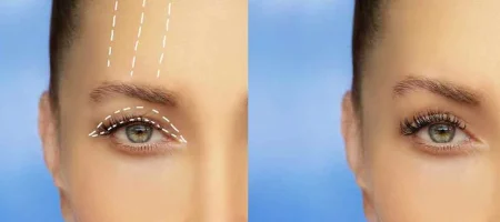 goz-kapagi-ameliyati