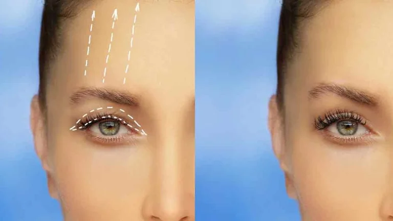 Eyelid Surgery (Blepharoplasty)