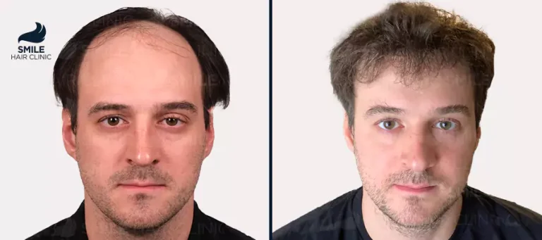 Transplantimi i Flokëve në Turqi: Udhëzues i Plotë për Kostot, Procedurat dhe Rezultatet në vitin 2026