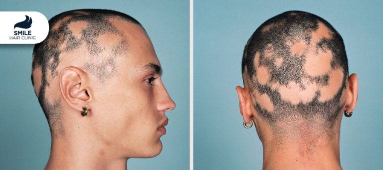 Androgenetic Alopecia Male Pattern Baldness