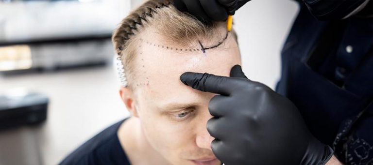 When Can I Wear a Hat or Helmet After Hair Transplant? Safe Timelines & Tips